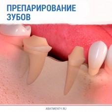 Что нужно знать технику о препарировании зубов под протезы
