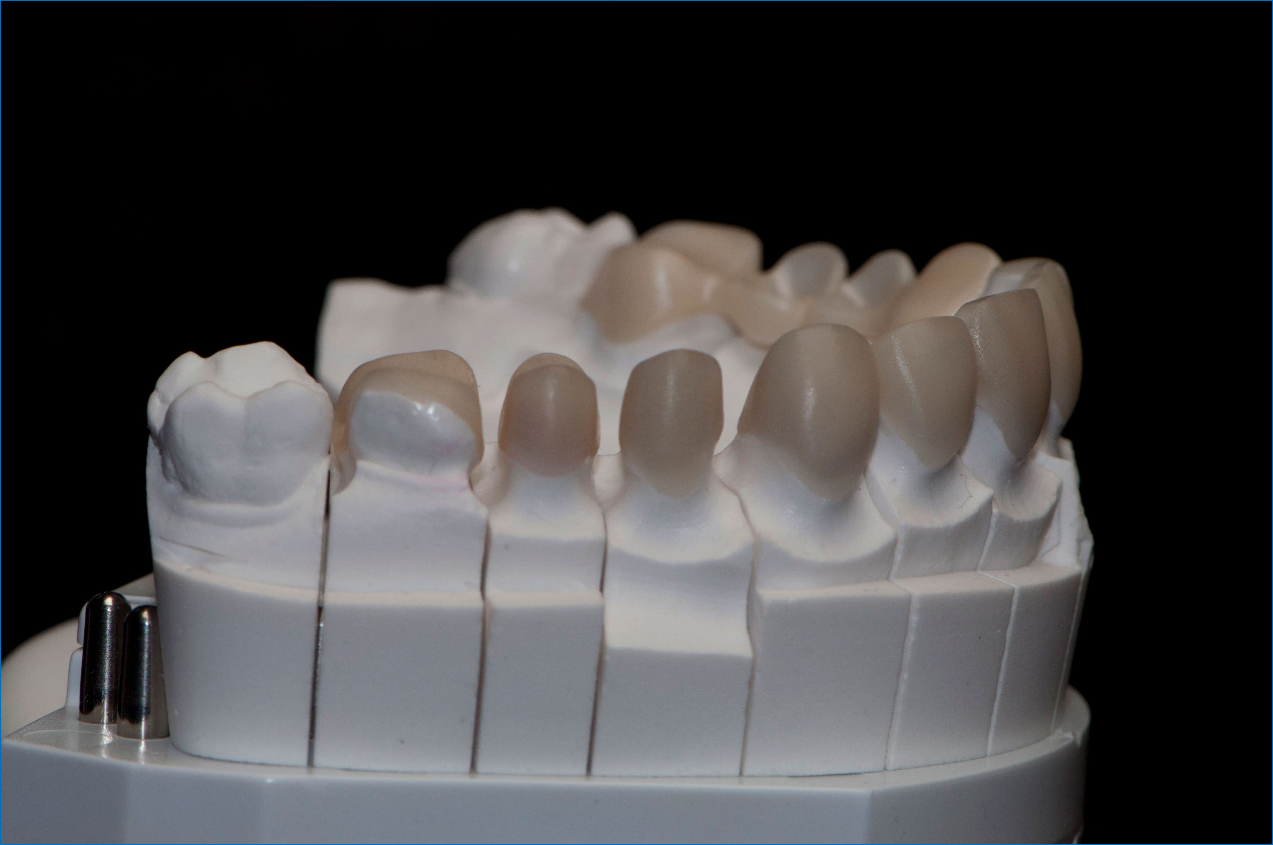 Изготовление гипсовой модели. Гипсовая модель зубов. Разборная гипсовая модель. Гипсовые модели в стоматологии. Гипс в стоматологии ортопедической.