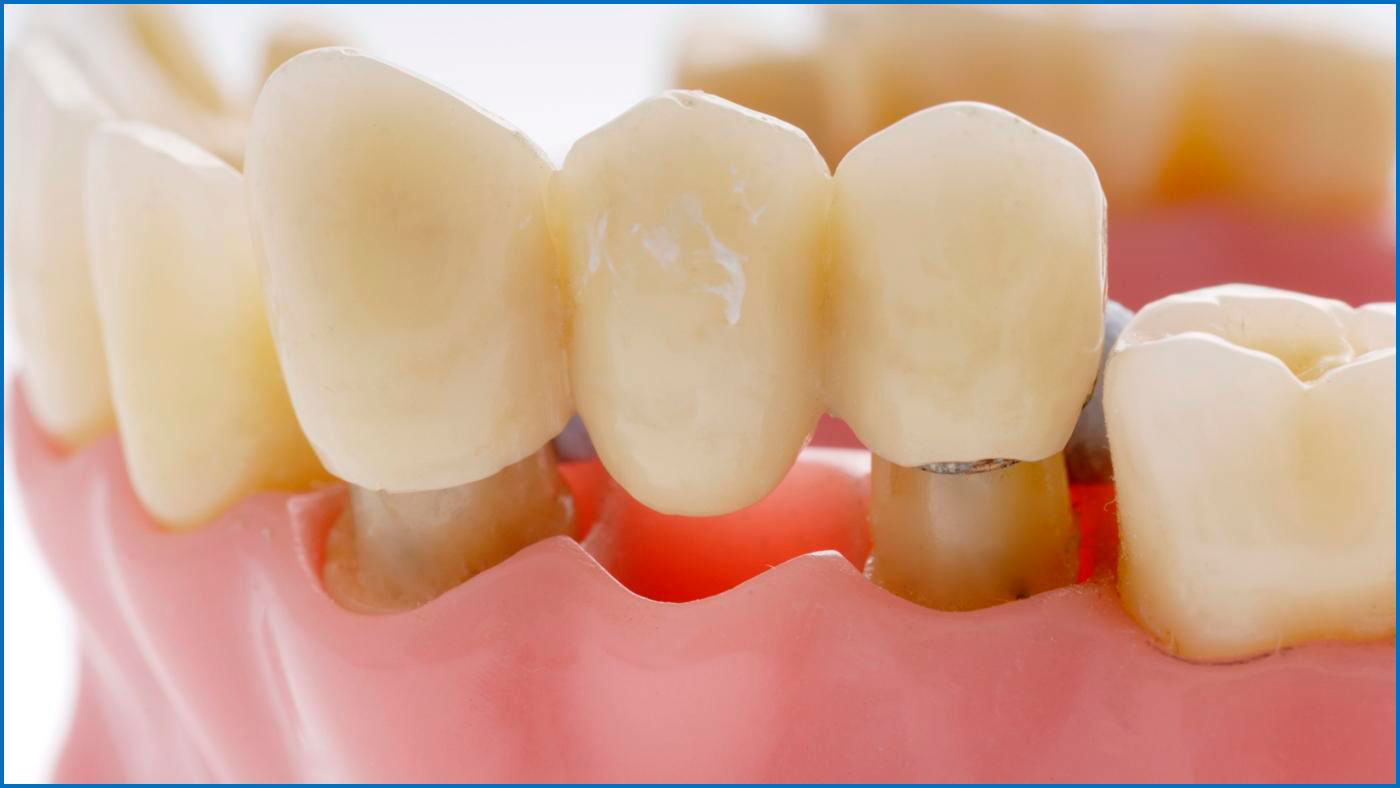 как выглядят мосты в стоматологии
