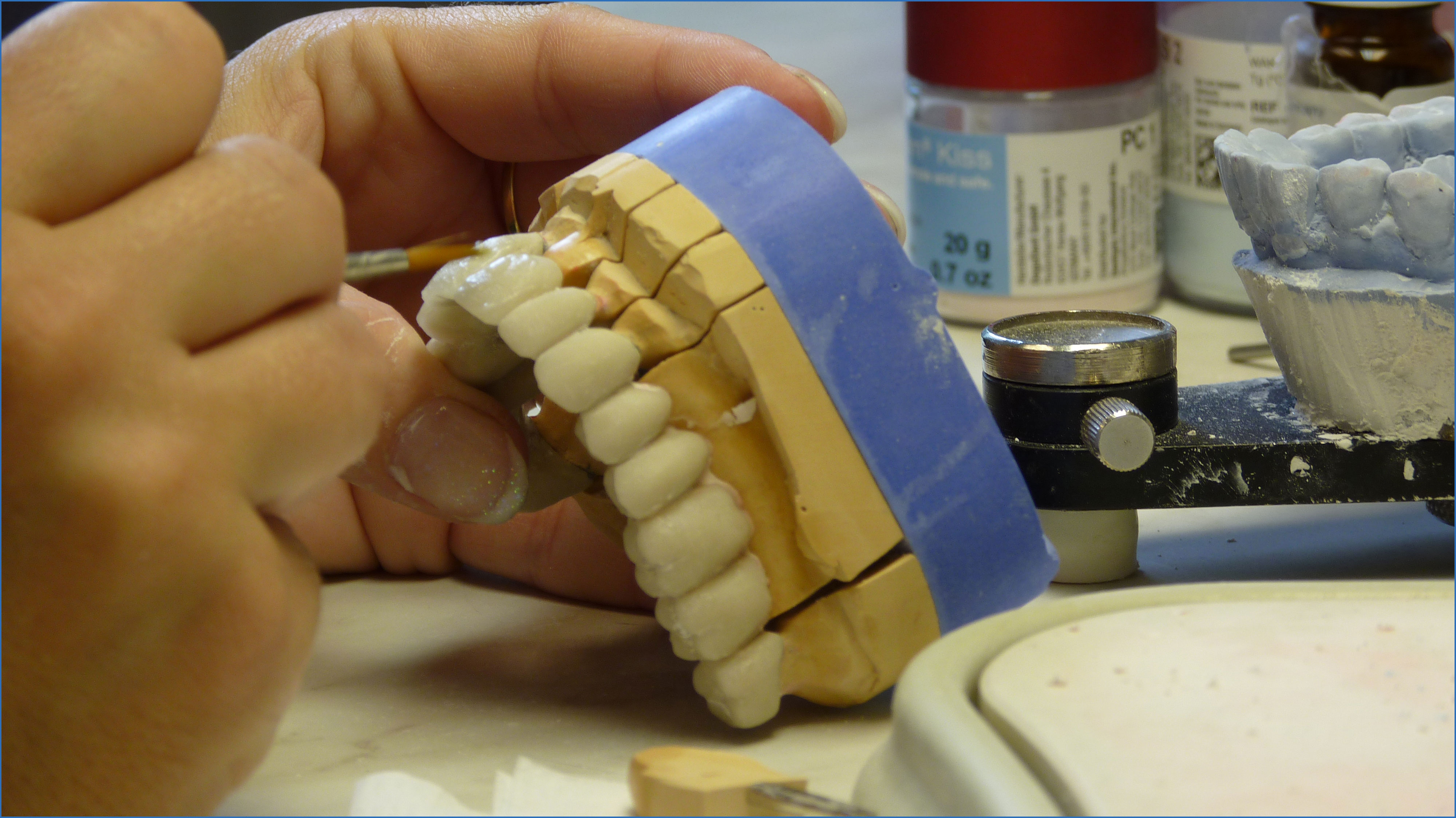 Изготовление металлокерамического протеза. Лабораторные этапы мостовидного протеза. Восковое моделирование мостовидного протеза. Пластмасса для мостовидного протеза. Керамический мостовидный протез.