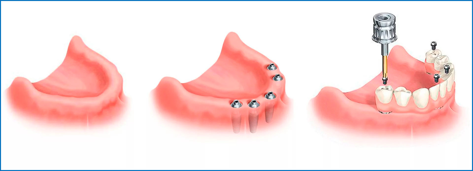 Протез на имплантах при полном отсутствии. Условно-съёмный протез ( all-on-4). Протез на 2 имплантах на нижнюю челюсть. Резекционный протез на нижнюю челюсть. Протез на 2 имплантатах на нижней челюсти.